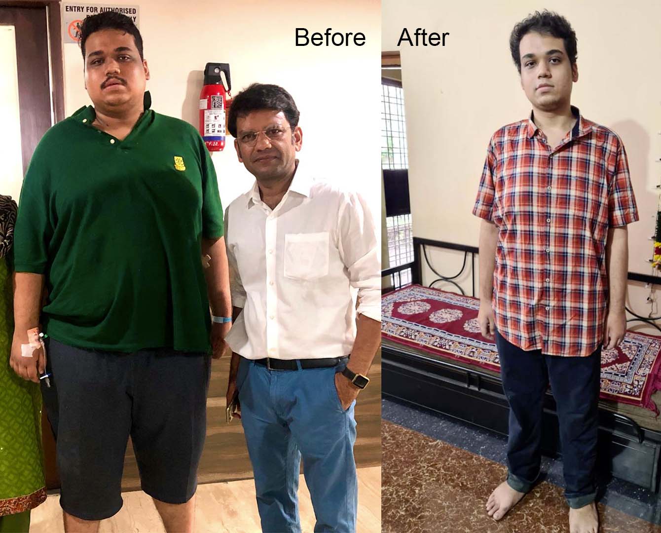 Best Laparoscopic & Bariatric Surgeon Before and After results of Bariatric or Obesity Metabolic Surgery by Bariatric Surgeon Dr Prashant Verma