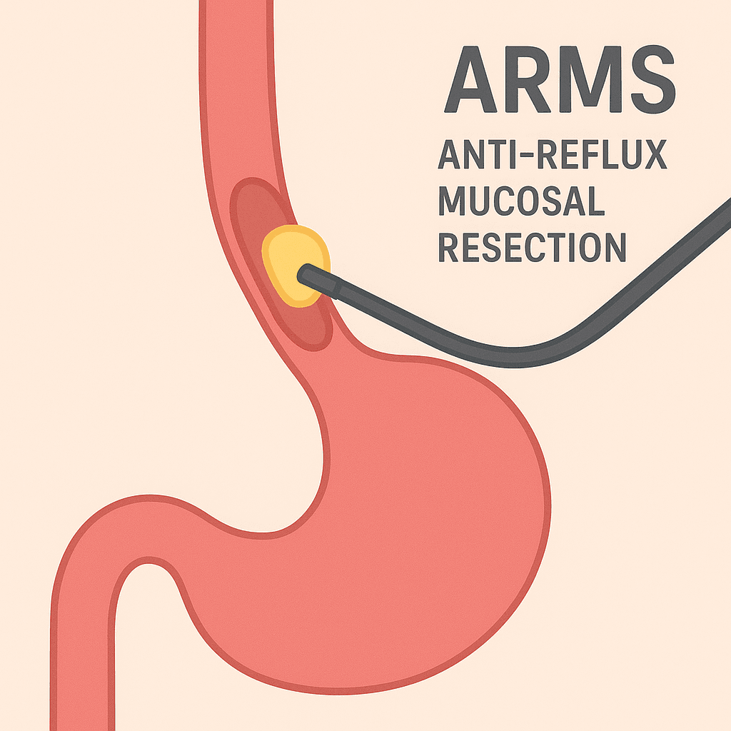 Fundoplication