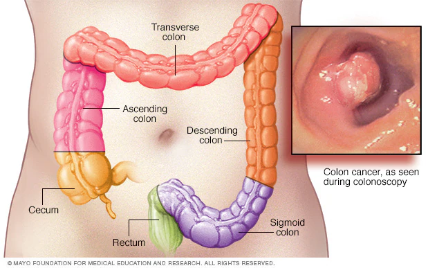 bowel Resection
