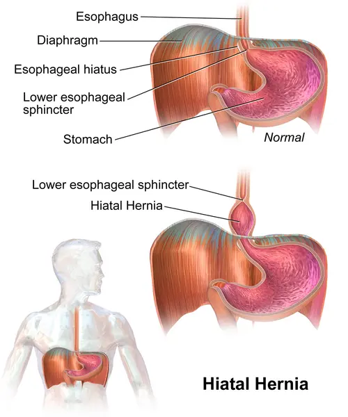 Hiatus Hernia