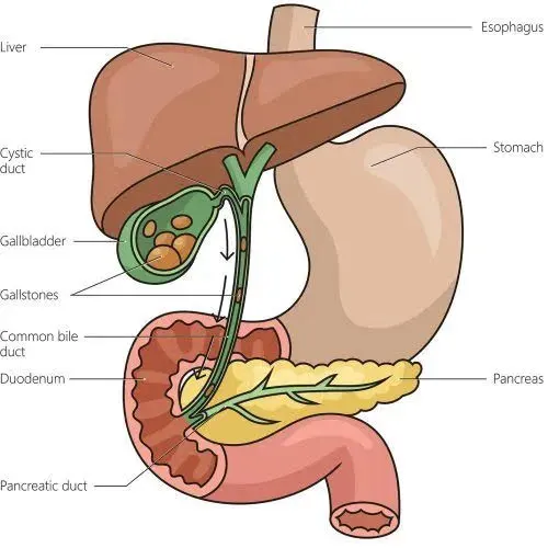 Cholecystectomy