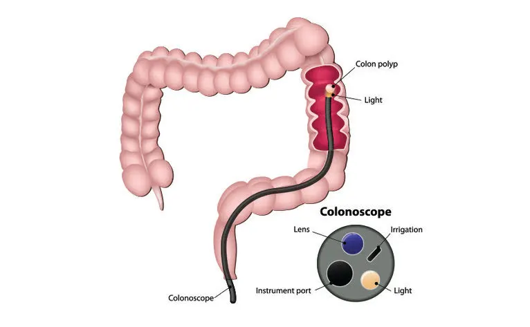 Colonoscopy