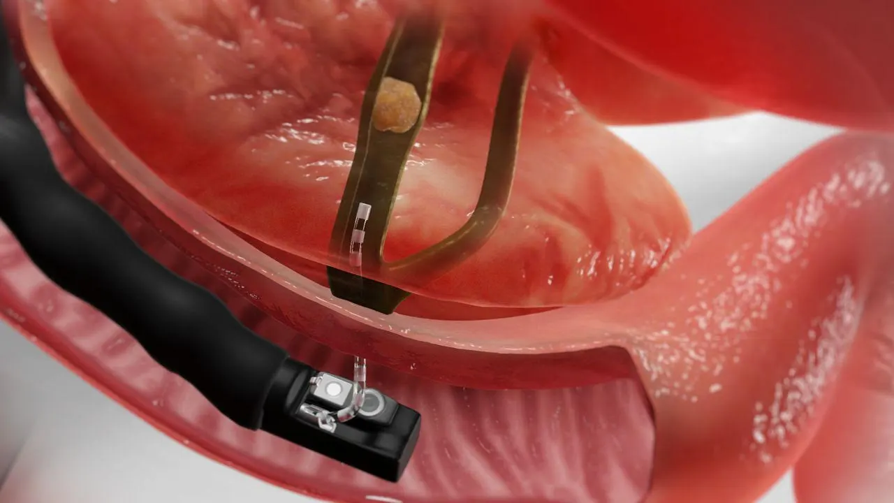 ERCP Procedure