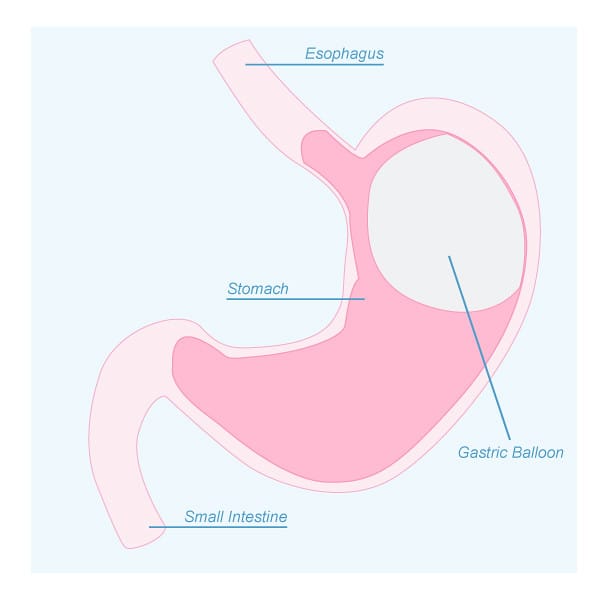 gastric balloon surgery diagram