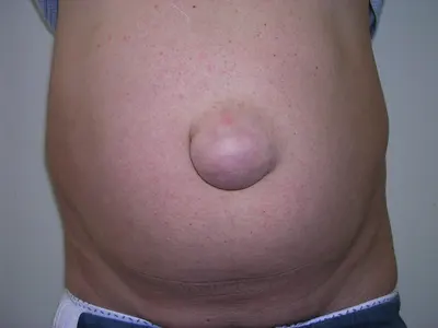 Hernia Surgery