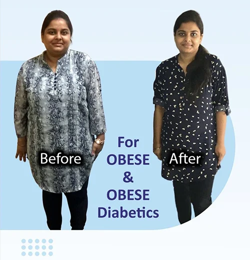 Weight Loss Surgery Result by Dr Prashant Verma
